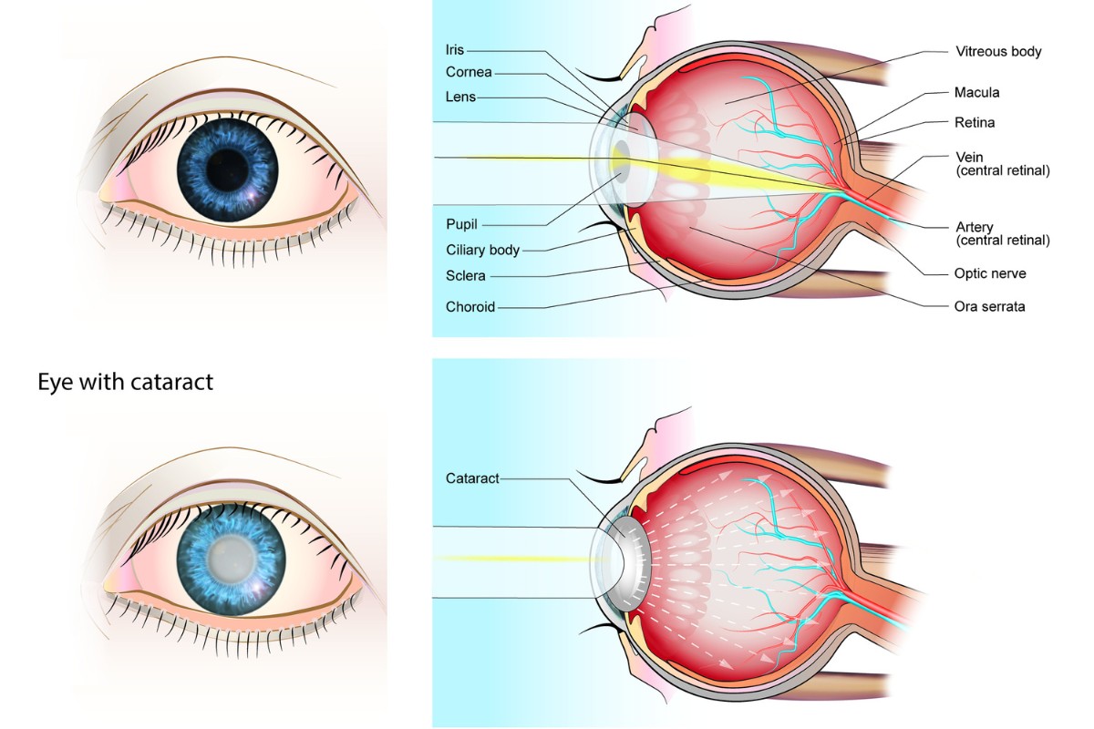 Cataract