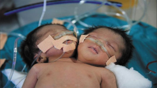 Cặp song sinh bị dính liền nhau - Babies with one body
