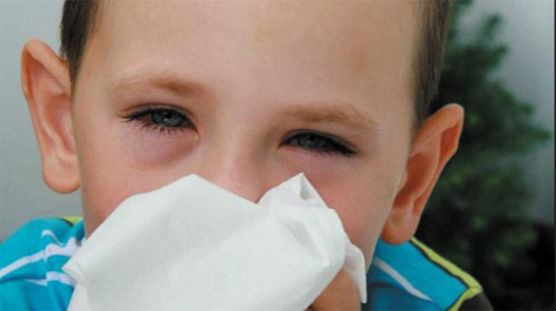 Dị ứng mắt - Eye allergies
